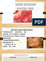 Neoplasias Malignas en Cavidad Oral