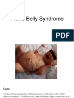 Prune Belly Syndrome