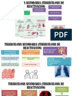 Tuberculosis Secundaria