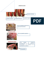 Apendicitis Aguda