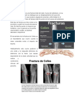 Fractura de Colles