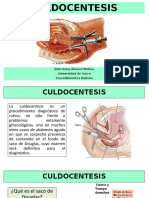 Culdocentesis