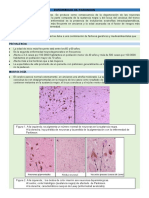 Enfermedad de Parkinson