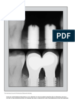 Crestal Bone Changes On Platform - Switched Implants and Adjacent Teeth When The Tooth-Implant Distance Is Less Than 1.5 MM