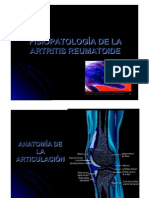 Artritis Reumatoide