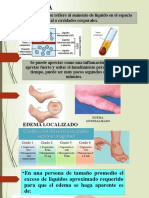 Edema 1