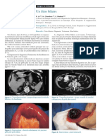 Ileus Bilaire