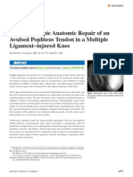 All Arthroscopic Anatomic Repair of An Avulsed Popliteus Tendon in A Multiple Ligamentinjured Knee