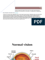 Astigmatism Exercises: Found Here