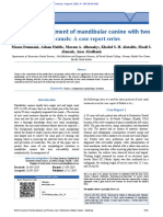 Root Canal Treatment of Mandibular Canine With Two Root Canals: A Case Report Series