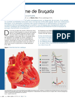 Syndrome Brugada 2 PDF