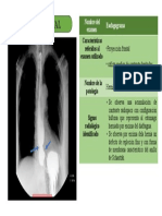 Hernia Hiatal - II2