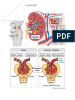 What Is Nephrotic Syndrome?: Nephroticsyndrome