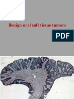 Benign Oral Soft Tissue Tumors