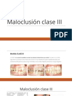 Maloclusión Clase III