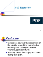 Cystocele & Rectocele