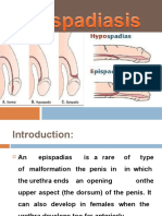 Epispadiasis