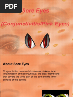 Sore Eyes (Conjunctivitis/Pink Eyes)