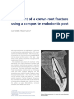 Treatment of A Crown-Root Fracture