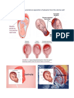 Abruptio Placenta and Abortion