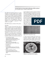 Congenital Toxoplasmosis Associated With Severe Intracerebral Calcification and West Syndrome