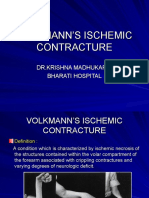 Volkmann's Ischemic Contracture