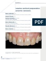 Minimally Invasive Vertical Preparation Design For Ceramic Veneers