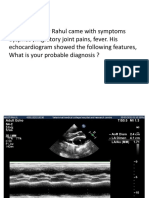 Mitral Stenosis