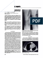 Presternal Soft Tissue Calcifications Following Mediastinal Radiotherapy For Hodgkin's Disease