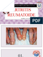 Artritis Reumatoide