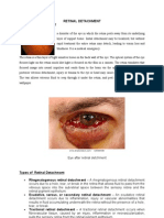 Retinal Detachment Nava Joanna D.