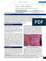 Oral Lichen Planus - A Case Report