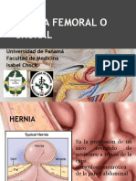 Herniafemoralocrural 170410042143