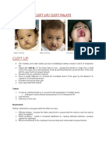 Cleft Lip Palate