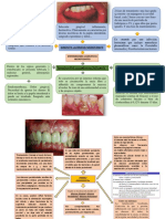 Acceso Periodontal, Lesiones Ulcerativas