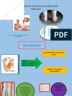 Alteraciones de La Postura Por Hipotonía Muscular