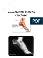 Síndrome Del Espolón Calcáneo