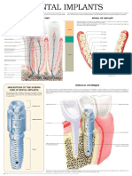 Dental Implants e Chart