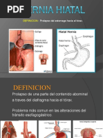 A.clase 1.6 Hernias Hiatal y Parahiatal 1.7 H. Diafragmaticas