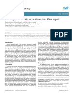 Misdiagnose of Acute Aortic Dissection: Case Report