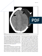 Decompressive Craniectomy For Acute Isquemic Stroke (09-16)