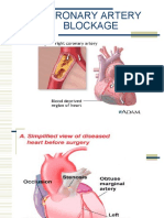 CABG Presentation