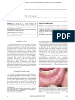 Queilitis Glandular: Casos Breves