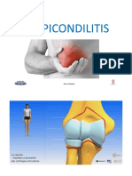 EPICONDILITIS