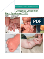 Chapter 9: Congenital Constriction Band Syndrome (CCBS)