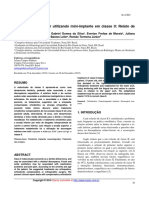 Art Distalização de Molar Utilizando Mini-Implante em Classe II Relato de Caso