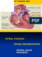 Mitral Valve