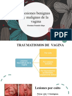 Lesiones Benignas y Malignas de La Vagina