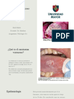 Carcinoma Verrucoso