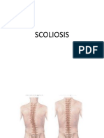 Scoliosis